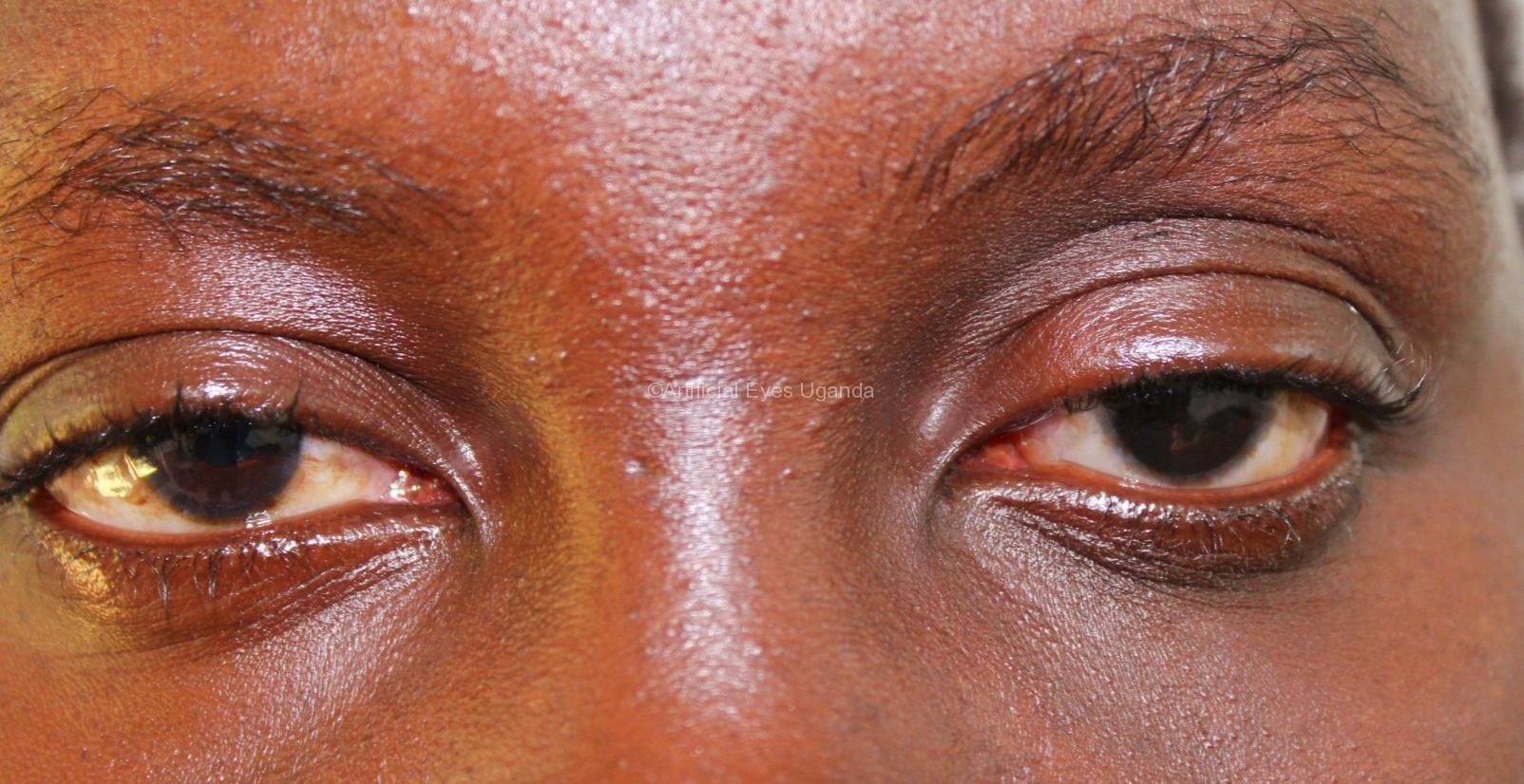 Minor Eye Procedures